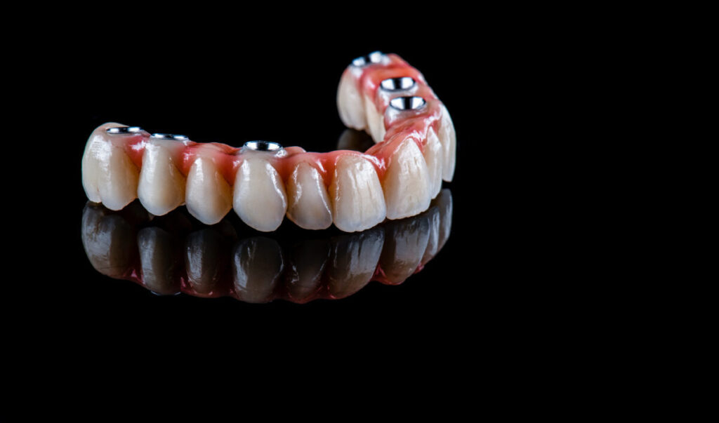 full arch dental implants