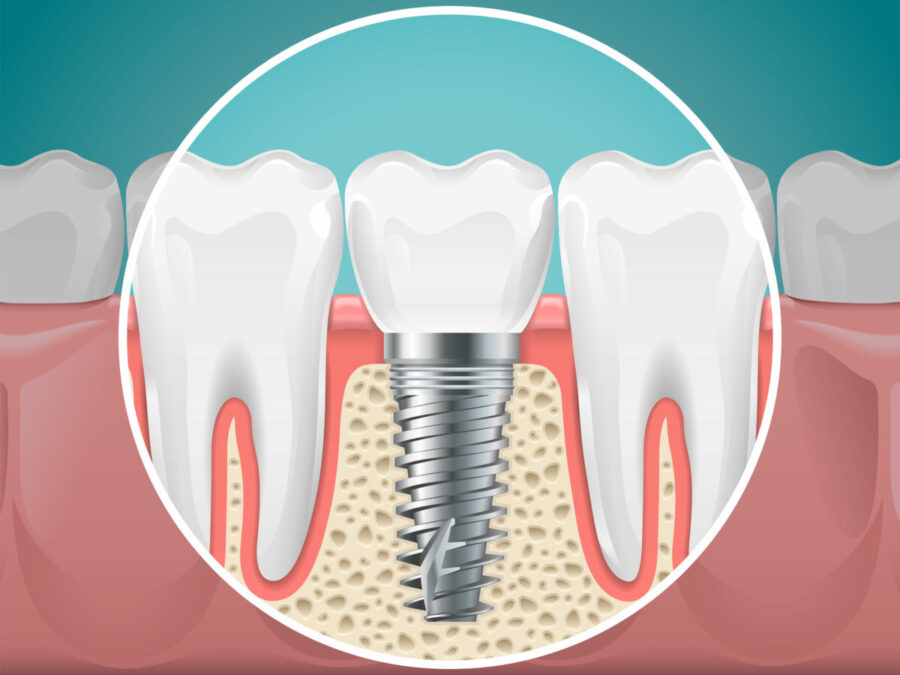 all on 6 dental implants