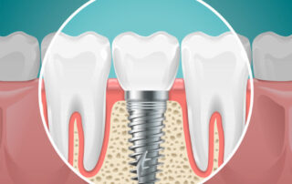 all on 6 dental implants