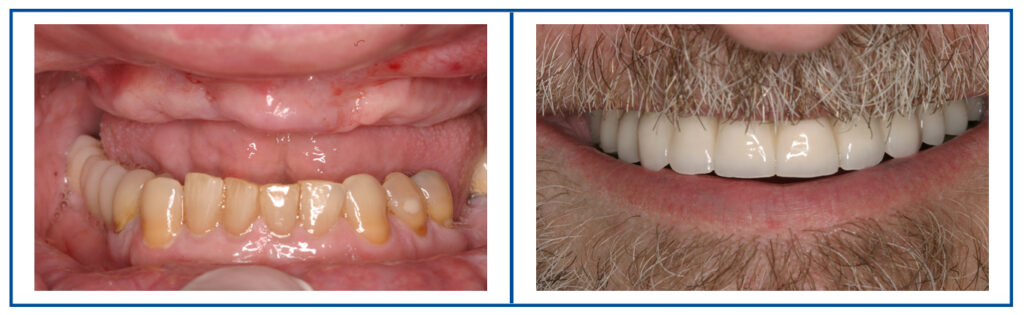 dental implants before and after