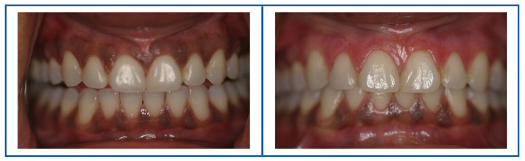 Gum Bleaching Before and After