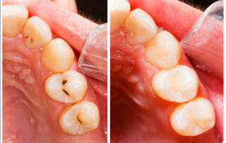 tooth fillings los angeles
