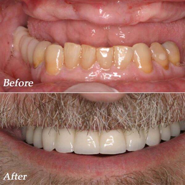 Chipped Tooth Repair Cost Southland dental Care