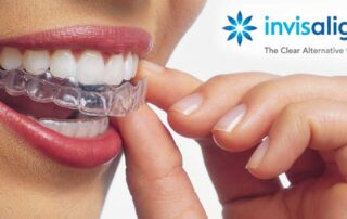 invisalign picture
