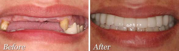 Complete mouth Dental Implants Before and After