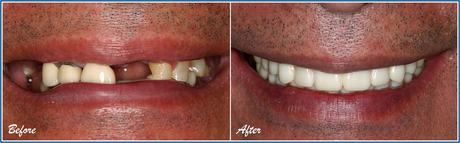 all on x dental implants before and after
