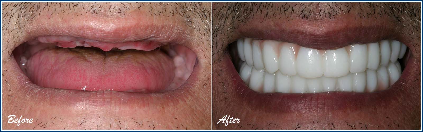 Dental Implants Before and After