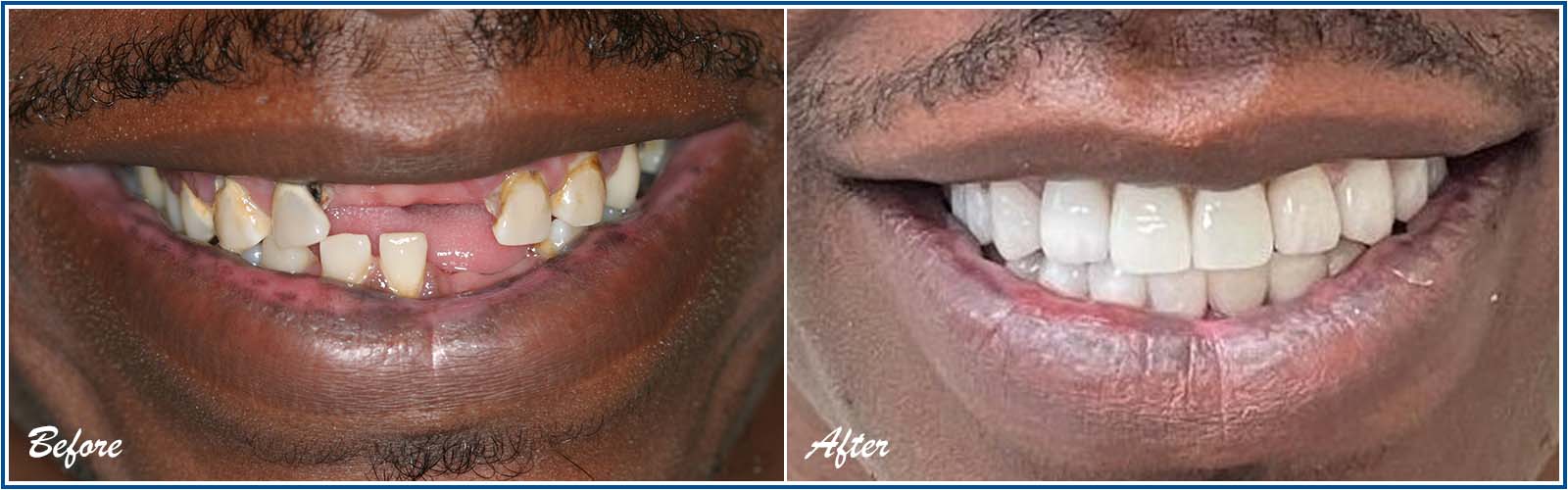 dental implants before and after