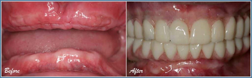 Dental Implants before and After