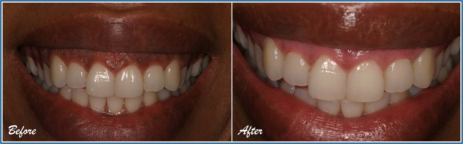 gum bleaching before afters