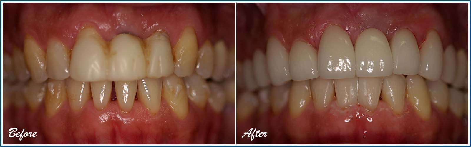 Porcelain Veneers Before and After