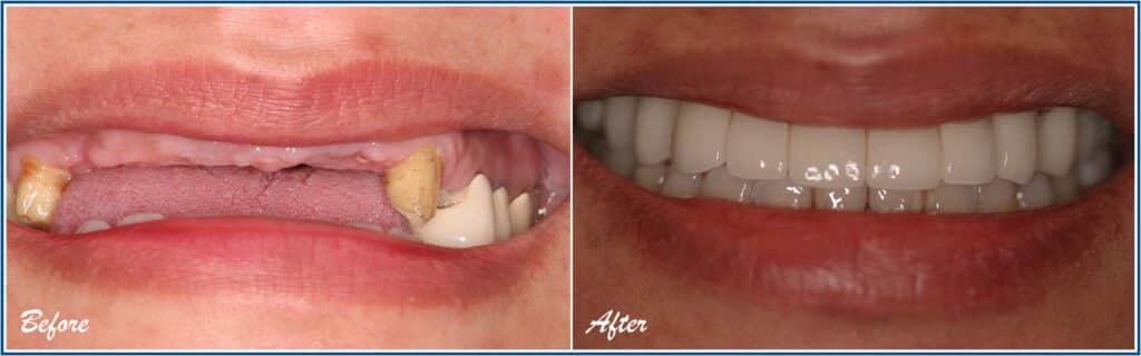 Dental Implants Surgery Before and After