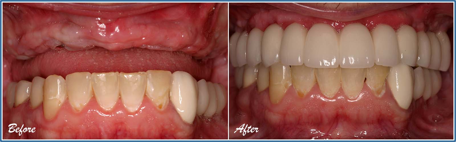 implant supported denture before and after