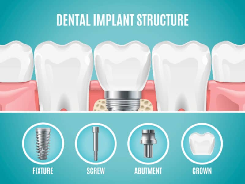 Understanding the Dental Implants Timeline