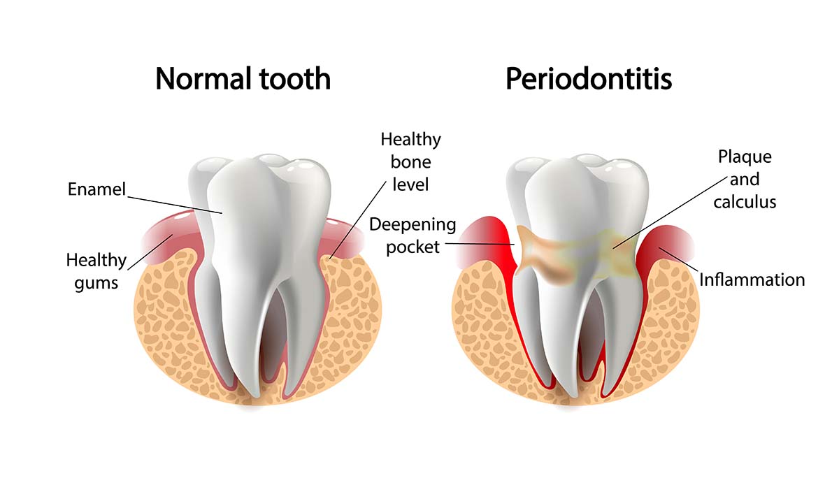 Periodontitis