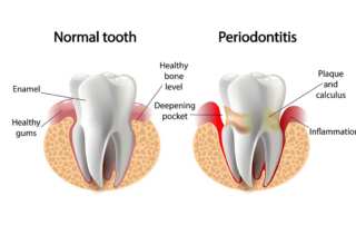 Periodontitis