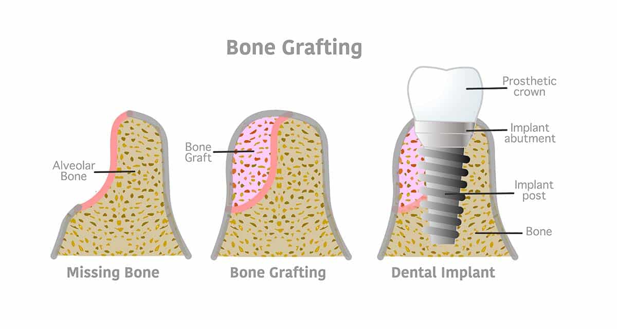bone graft dental implants