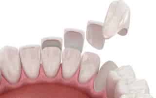 composite veneers vs porcelain veneers